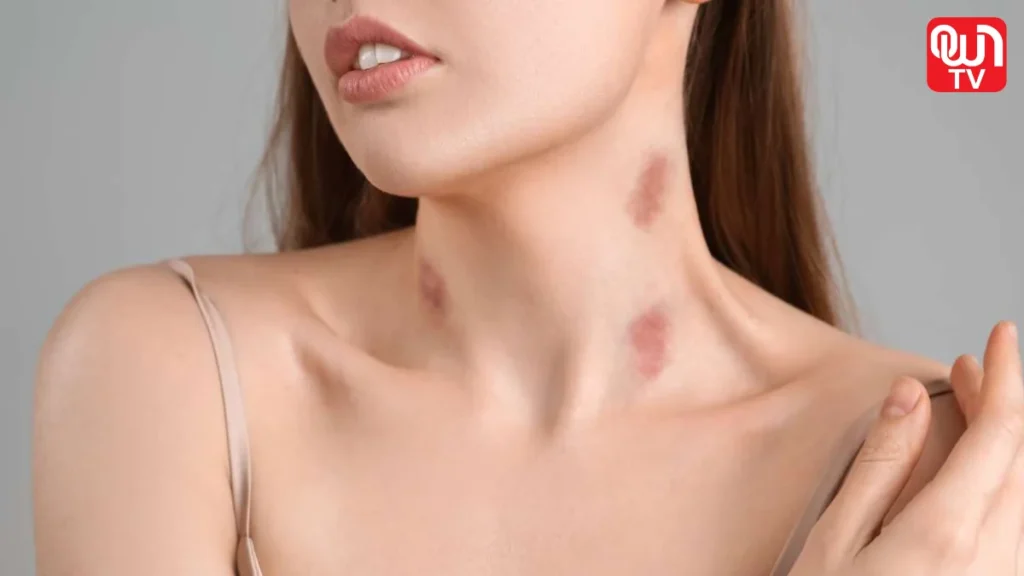 dream about Hickeys